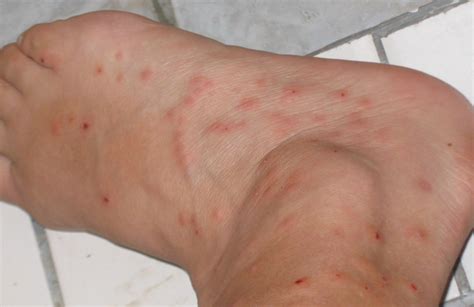 Cold weather rash or bed bug bites, what is the difference? - Bedbug Inspector : Canine Bed Bug ...