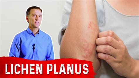 Lichen Planus: Best Remedy - YouTube