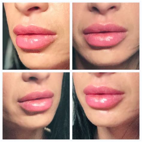 Pin by Adam Mauer MD on Lip injections | Lip injections, Injectables ...