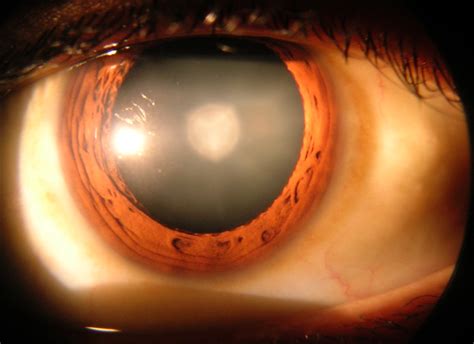 Cataract surgery - Wikipedia