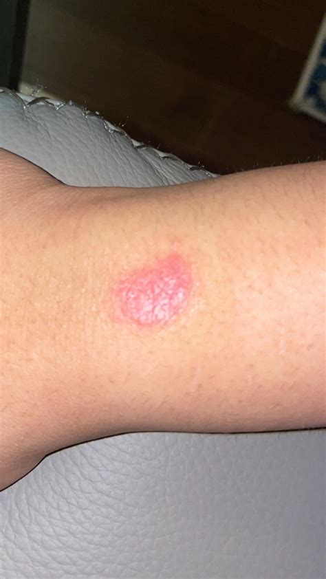 is my apple watch giving me a rash? : r/AppleWatch