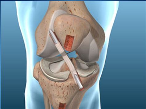 ACL Tears and Surgery - Physiotherapy Victoria BC