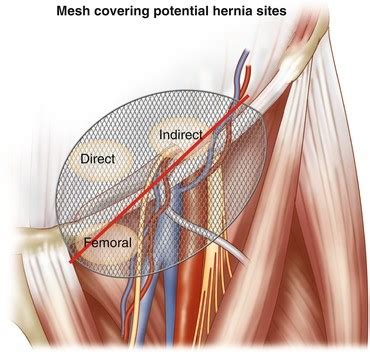 Laparoscopic Inguinal Hernia Repair: TAPP | SpringerLink