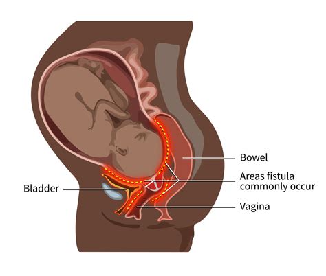 Media Resources - Fistula Foundation