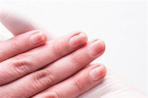 Infected cuticles: causes and the best treatment for cuticle damage