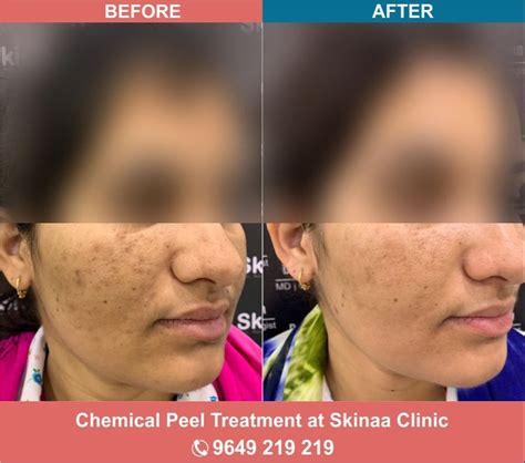 Chemical Peeling Skin Treatment Service at Rs 400/consultation in Jaipur