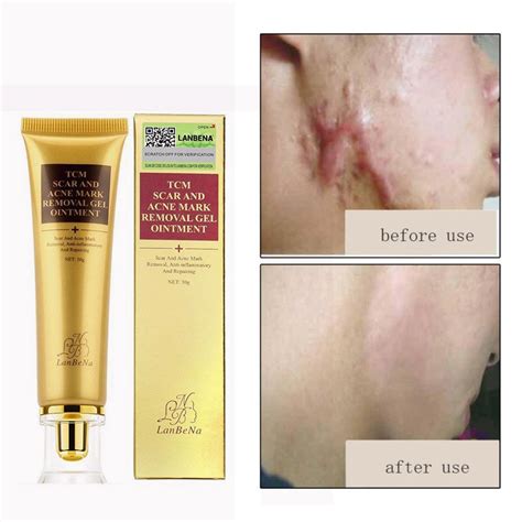 30 ml Profession Acne Scar Removal Cream Skin Repair Face Cream Acne Spots Acne Treatment ...