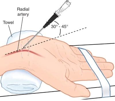 Arterial Line Placement: Basics for Medical Students EMRA