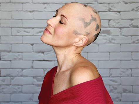 Alopecia Universalis Woman