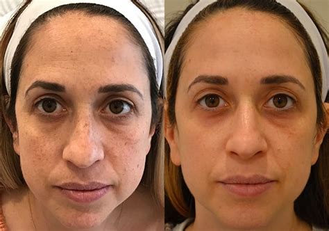 BBL Photofacial Before After Photos - FRESH FACE + EYE