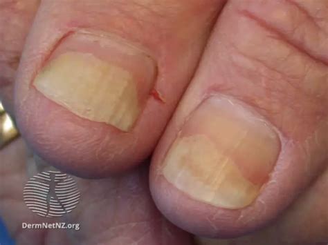 What Do Your Nails Look Like With Kidney Disease? | MyKidneyDiseaseCenter