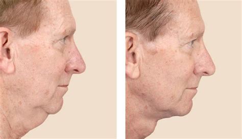 Neck Lift (Platysmaplasty): Surgery, Recovery & What to Expect