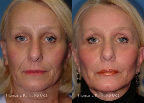 Mini Face Lift Facial Cosmetic Surgery Associates | Facial Cosmetic ...