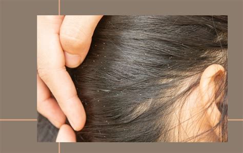 Do Lice Like Clean Hair? How To Prevent? [5 Easy Ways]