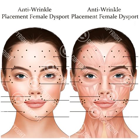 Dysport Injection Points Bundle Botox & Filler Injector Anatomy Poster ...