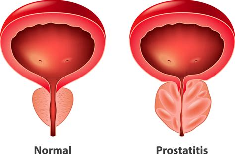 What Is Prostatitis? | PainScale