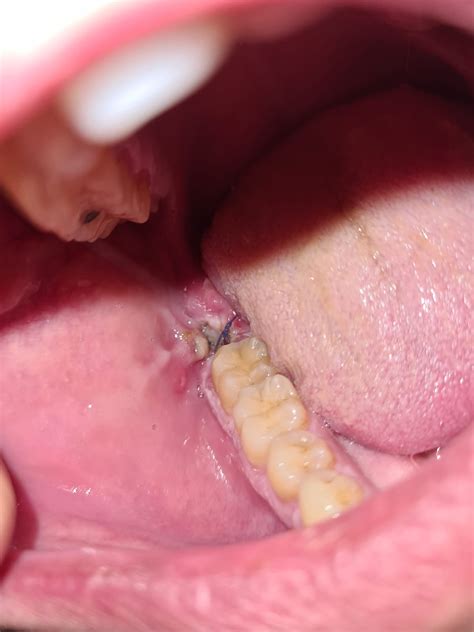 Wisdom tooth removal post-op white granulation tissue? (Picture) : r/wisdomteeth