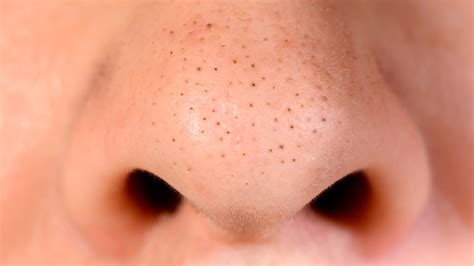 Here's What You Need To Know Before Removing Blackheads