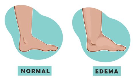 Edema - Cause, Symptoms, Treatment