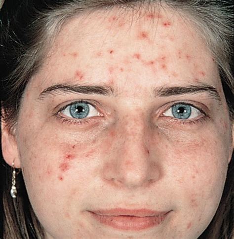 A woman with Acne | Visage, Beauté