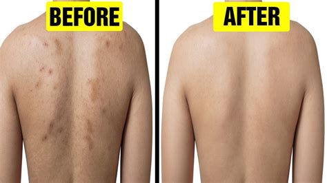 Back Acne Scars Treatment Philippines at Jenny Schneider blog