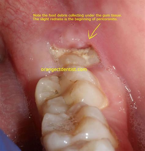 How Long Do Cuts Inside The Mouth Take To Heal at mariamvalenzuela blog