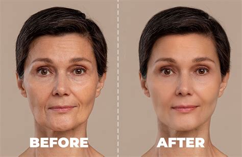 Radiesse: A More Youthful Look