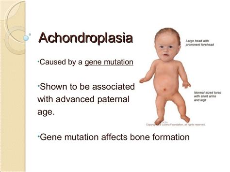 Pin by melissa gascon on diseases for review | Achondroplasia ...