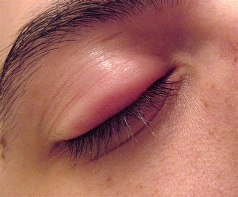 AStepAway - New Search Experience | Swollen eyelid, Swollen eyelids remedy, Swollen eye remedies