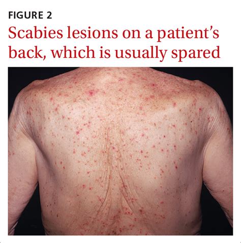 Scabies: Refine your exam, avoid these diagnostic pitfalls | MDedge Family Medicine