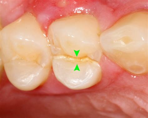 Cracked Tooth Boco Dental Prosthodontics