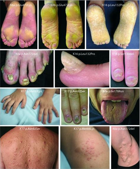 Clinical features of pachyonychia congenita (PC). Palmoplantar ...