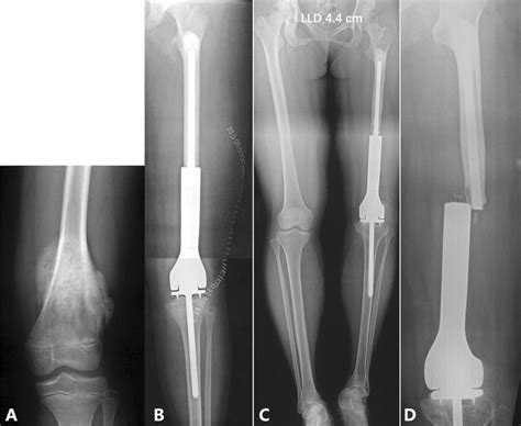 An innovative staged prosthetic lengthening reconstruction strategy for osteosarcoma-related leg ...