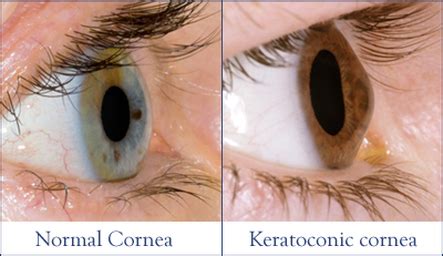 Dr. Meskin Performs Connecticut's First Corneal Collagen Crosslinking (CXL) Procedures with FDA ...