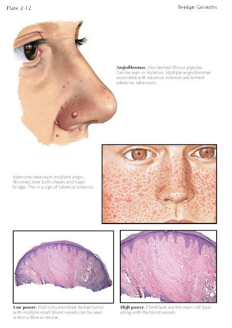 FIBROUS PAPULE - pediagenosis