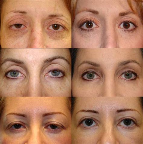 Ptosis Surgery or Blepharoplasty Surgery - Dr. Guy Massry