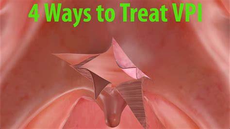 4 Ways to Treat Velopharyngeal Insufficiency (VPI) - YouTube