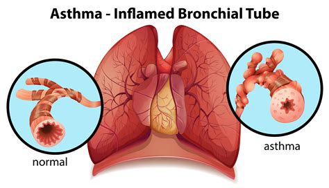 Asthma - ASAP Illinois