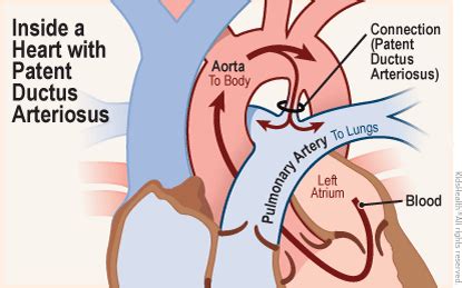 Patent Ductus Arteriosus (PDA) | Rady Children's Hospital