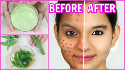 Pimples On Face Removal Tips