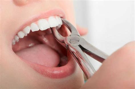 How to Prepare for a Tooth Extraction