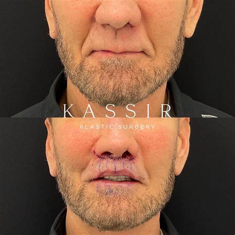 Best Male Lip Lift NYC — Kassir Plastic Surgery in NY and NJ