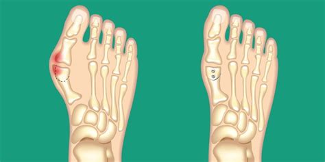 8 Effective Solutions For Bunion Pain | Prevention