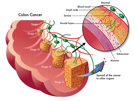 Staging Of Colon Cancer - Net Health Book