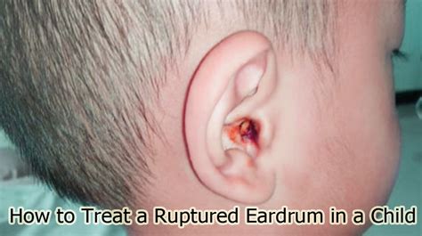 Formidable Info About How To Cure A Popped Ear - Unfuture38