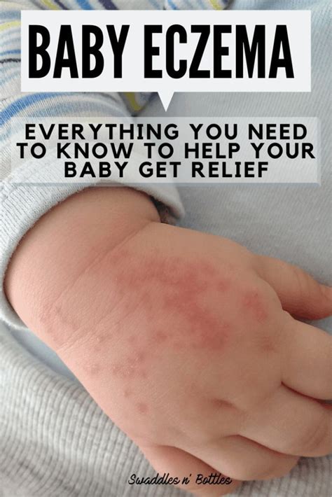 Baby Eczema: Causes and Remedies | Baby eczema, Baby eczema remedies, Baby eczema treatment