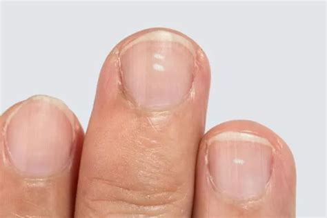 Three common nail problems – and what they could mean for your health ...