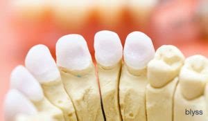 Zirconia Crowns: The Top 9 Questions You Should Ask Your Dentist