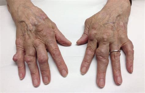 Rheumatoid Arthritis – RheumExam Atlas