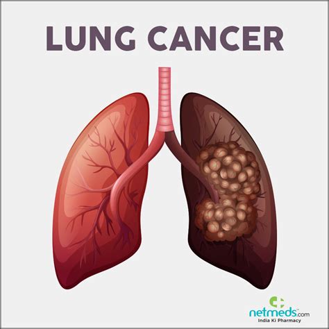 Lung Cancer: Causes, Symptoms And Treatment | Netmeds